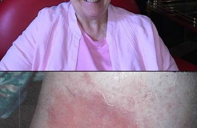 Chronic Open Wound Healed