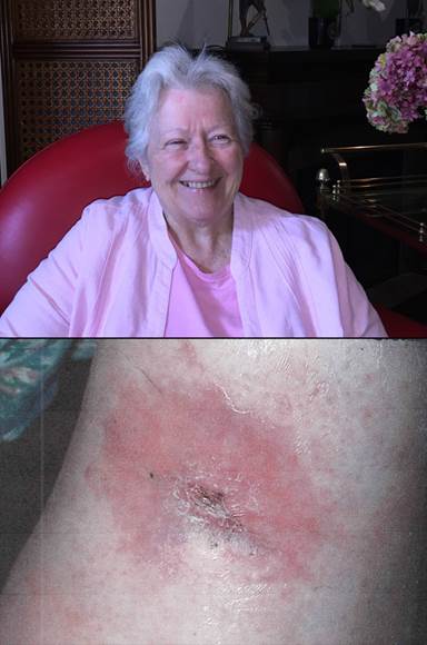 Chronic Open Wound Healed